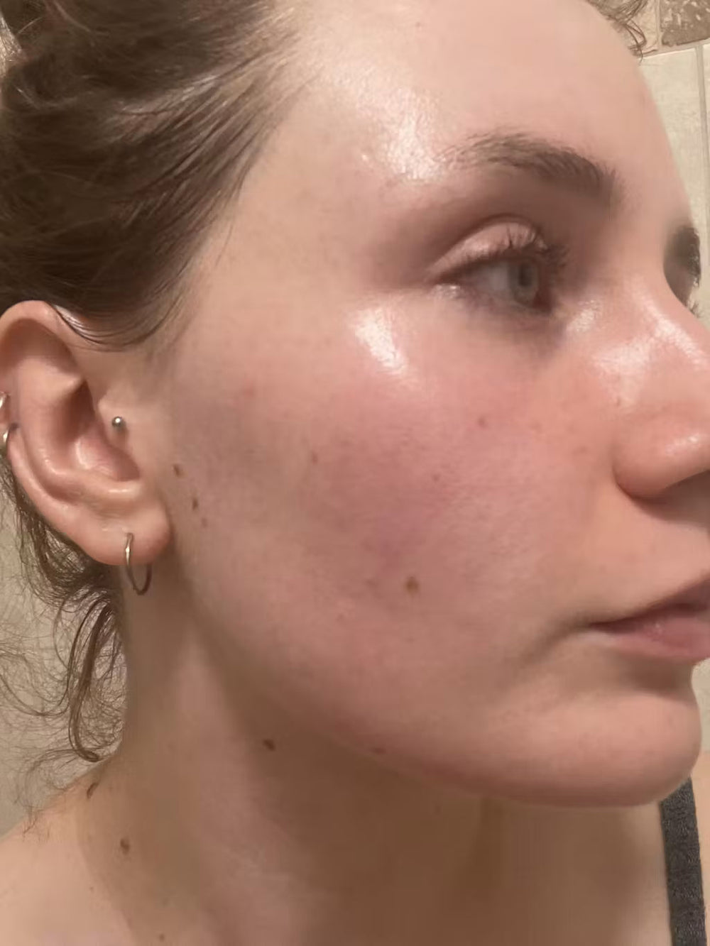 acne AL keep