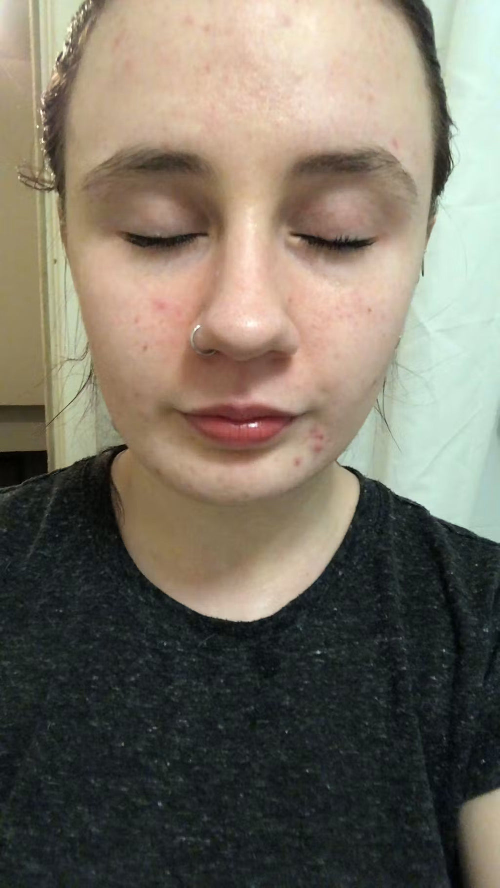 acne AL keep
