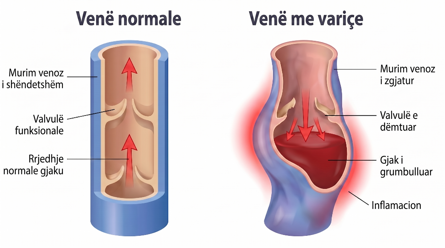 periodontis