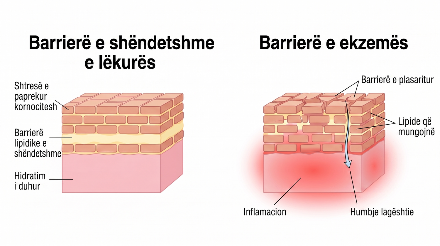 eczema_AL_skin_barrier_v2.png